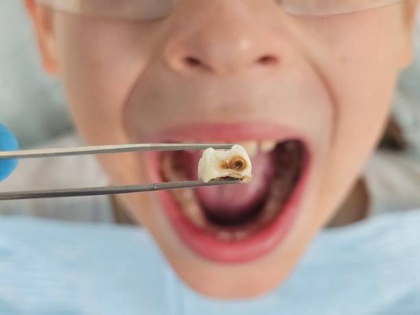 Best Broken or Cracked Tooth Emergency Dentist in Kenwood Estates, FL